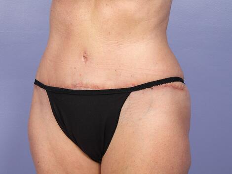 Liposuction Before & After Image