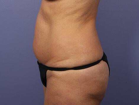 Liposuction Before & After Image