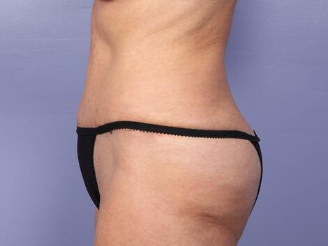 Liposuction Before & After Image