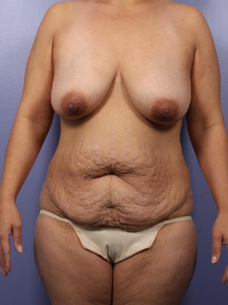 Liposuction Before & After Image