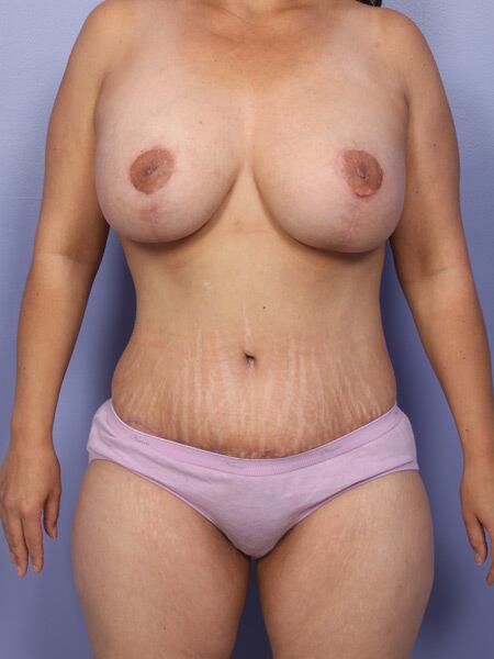 Liposuction Before & After Image