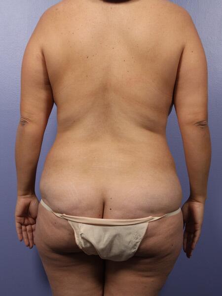 Liposuction Before & After Image