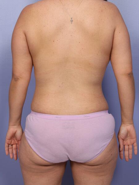 Liposuction Before & After Image