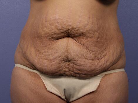 Liposuction Before & After Image