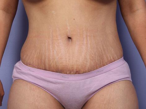 Liposuction Before & After Image