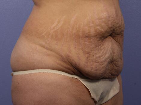 Liposuction Before & After Image