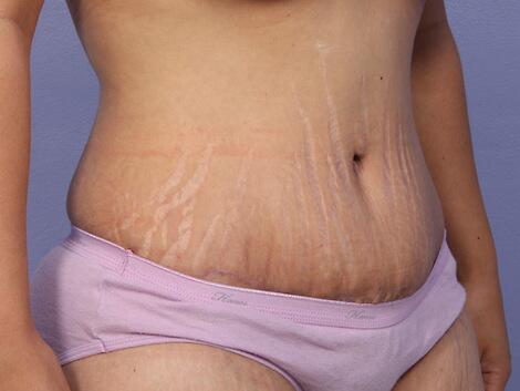 Liposuction Before & After Image