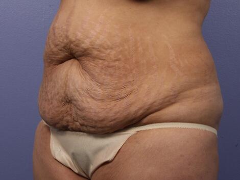 Liposuction Before & After Image