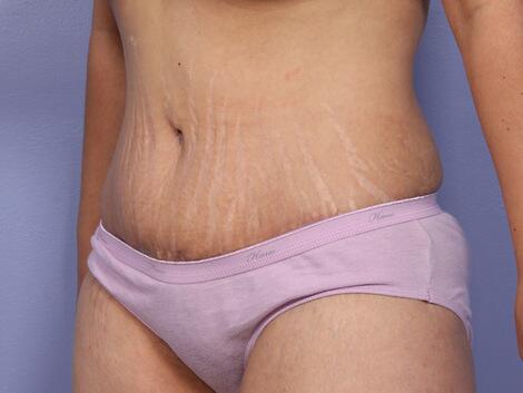 Liposuction Before & After Image