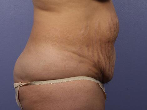 Liposuction Before & After Image