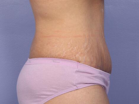 Liposuction Before & After Image