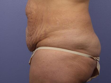 Liposuction Before & After Image