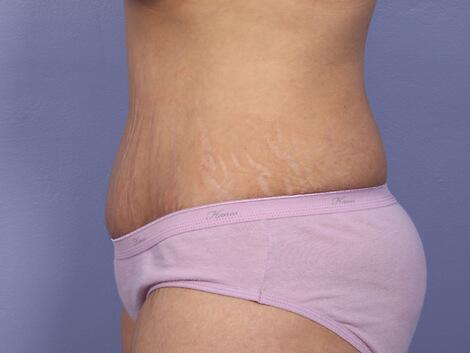 Liposuction Before & After Image