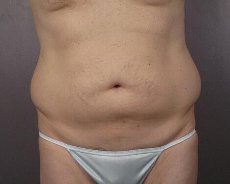 Liposuction Before & After Image