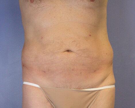 Liposuction Before & After Image