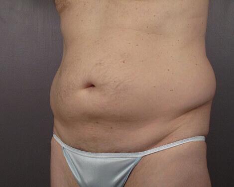 Liposuction Before & After Image