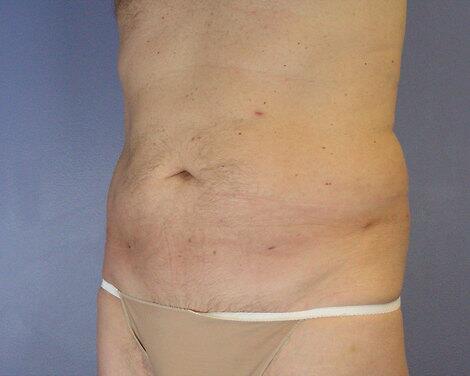 Liposuction Before & After Image