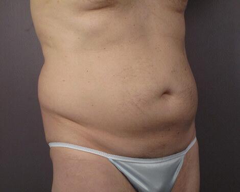 Liposuction Before & After Image