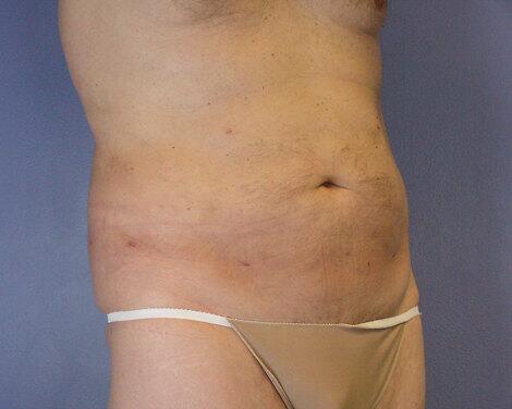 Liposuction Before & After Image