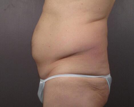 Liposuction Before & After Image