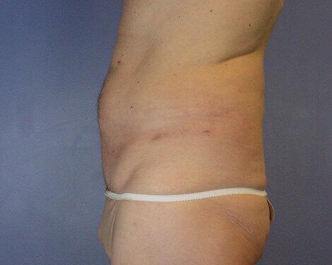 Liposuction Before & After Image