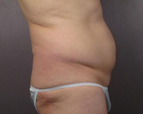 Liposuction Before & After Image