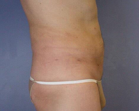 Liposuction Before & After Image