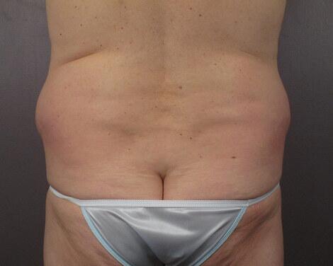 Liposuction Before & After Image