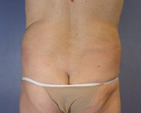 Liposuction Before & After Image