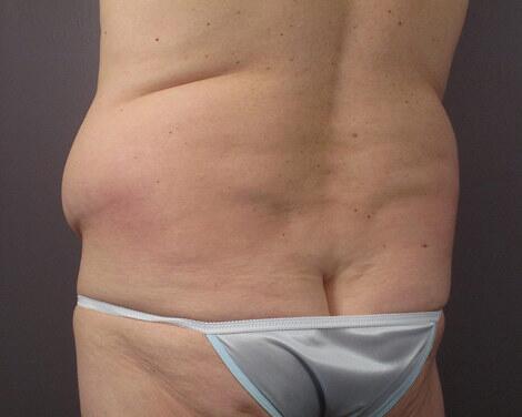 Liposuction Before & After Image