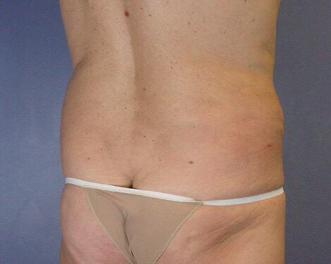 Liposuction Before & After Image