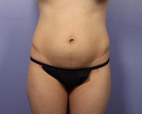 Liposuction Before & After Image