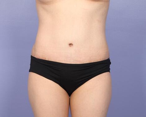 Liposuction Before & After Image