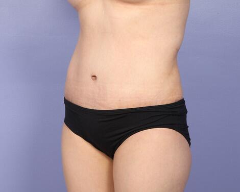 Liposuction Before & After Image