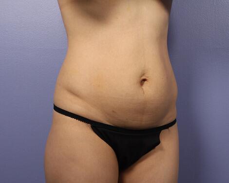 Liposuction Before & After Image