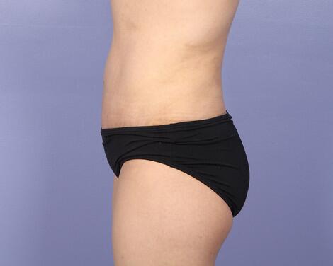 Liposuction Before & After Image