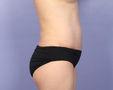 Liposuction Before & After Image