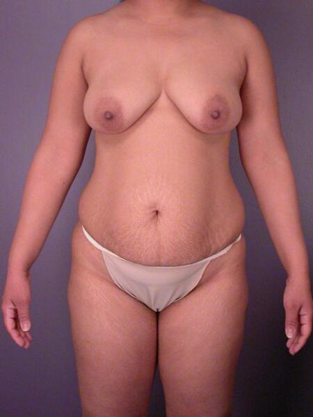 Liposuction Before & After Image