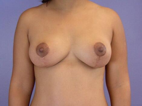 Liposuction Before & After Image