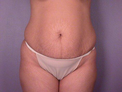 Liposuction Before & After Image