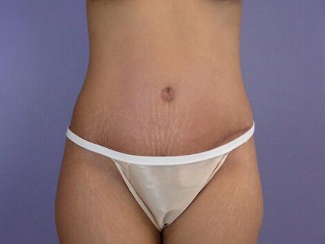 Liposuction Before & After Image