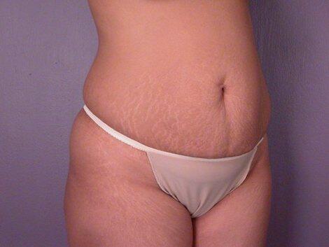 Liposuction Before & After Image