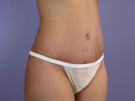 Liposuction Before & After Image