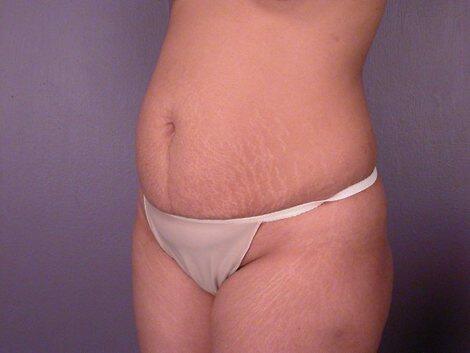 Liposuction Before & After Image