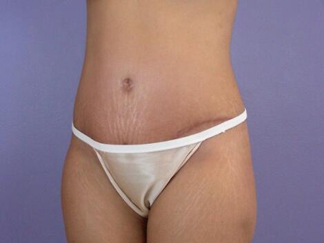 Liposuction Before & After Image