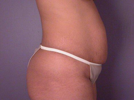 Liposuction Before & After Image