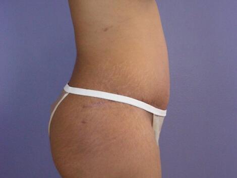 Liposuction Before & After Image