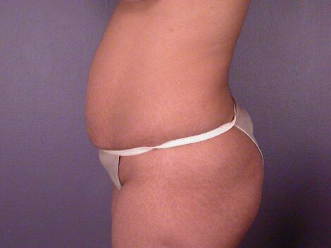 Liposuction Before & After Image