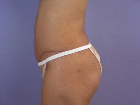 Liposuction Before & After Image