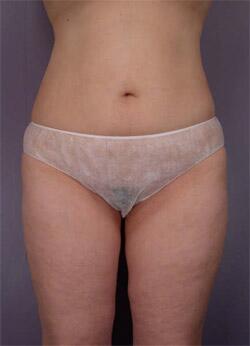 Liposuction Before & After Image